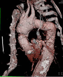 Type A Dissection - CTisus CT Scan