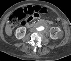 Abdominal Aortic Aneurysm (AAA) With Prior Extravasation - CTisus CT Scan