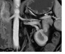 Incidental Left Renal Artery Stenosis - CTisus CT Scan