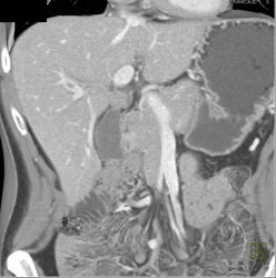 Pancreatic Cancer Encases the Superior Mesenteric Vein (SMV) and Splenic Vein. Clot in Portal Vein Also Seen - CTisus CT Scan