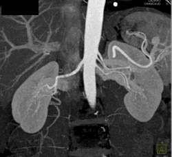 3 Left Renal Arteries in A Potential Renal Donor - CTisus CT Scan