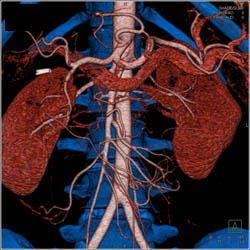 Iliac Arteries in Profile - CTisus CT Scan