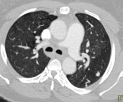 Thickening Around Trachea and Lung Nodules Which Actually Are Pulmonary Arteriovenous Malformations (PAVMs) - CTisus CT Scan