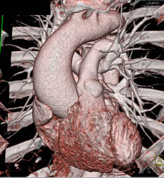 Dilated Ascending Aorta - CTisus CT Scan