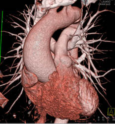 Dilated Ascending Aorta - CTisus CT Scan