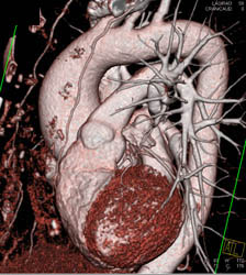 Dilated Ascending Aorta - CTisus CT Scan