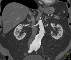 Abdominal Aortic Aneurysm (AAA) Into Iliacs - CTisus CT Scan