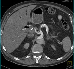 Type B Dissection - CTisus CT Scan