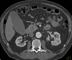 Type B Dissection - CTisus CT Scan