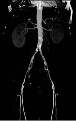 Peripheral Vascular Disease (PVD) With Bone Editing - CTisus CT Scan