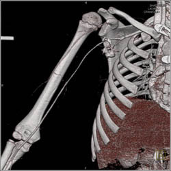 Axilla Trauma With Active Bleed - CTisus CT Scan