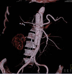 Aorta Dissection - CTisus CT Scan