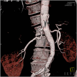 Incidental Right Fibromuscular Dysplasia (FMD) of Renal Artery - CTisus CT Scan