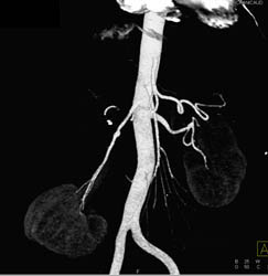 5mm Right Renal Artery Aneurysm - CTisus CT Scan