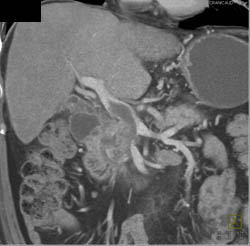 Pancreatic Cancer Invades the Portal Vein (PV) - CTisus CT Scan