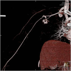 Injury to Axillary Artery With Bleed - CTisus CT Scan