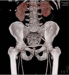 Patent Fem-fem Bypass Graft With Diseased Right External Iliac Artery - CTisus CT Scan