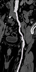 Vessel Mapping Shows Patent Iliac Artery - CTisus CT Scan