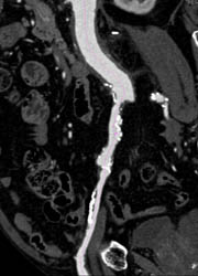 Patent Iliac Artery With Calcified Plaque - CTisus CT Scan