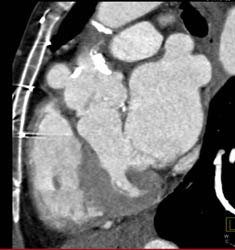 Dilated Right Coronary Artery - CTisus CT Scan