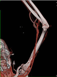 CTA of Brachial Artery With Av Shunt for Dialysis - CTisus CT Scan