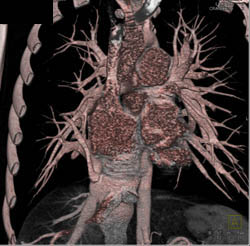 Total Anomalous Pulmonary Venous Return - CTisus CT Scan