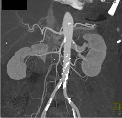 Diseased Aorta and Iliacs - CTisus CT Scan