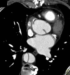 Type A Dissection - CTisus CT Scan