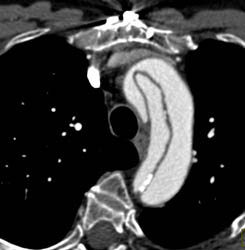 Type A Dissection - CTisus CT Scan