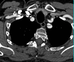 Type A Dissection - CTisus CT Scan