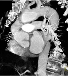 Type A Dissection - CTisus CT Scan