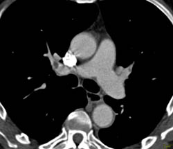 Pulmonary Embolism - CTisus CT Scan