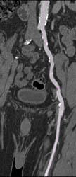 Patent Left Iliac/fem Artery - CTisus CT Scan