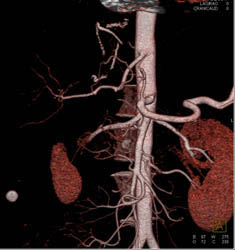 Patent SMA and Celiac Artery - CTisus CT Scan