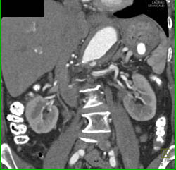 Splenic Artery Aneurysm - CTisus CT Scan