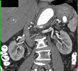 Splenic Artery Aneurysm - CTisus CT Scan