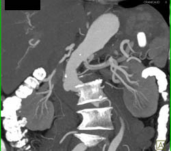 Splenic Artery Aneurysm - CTisus CT Scan