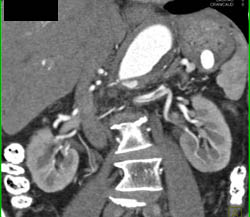 Splenic Artery Aneurysm - CTisus CT Scan