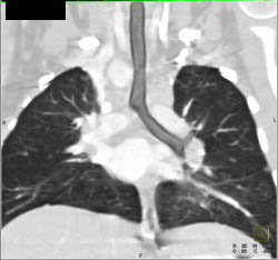 Normal Lunch Parenchyma - CTisus CT Scan