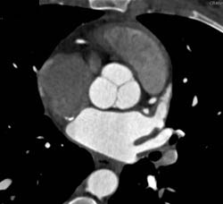 Normal Aortic Valve - CTisus CT Scan