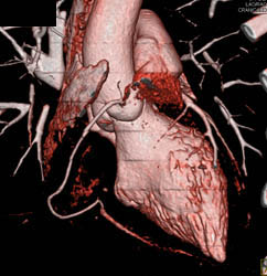 Normal Coronary Arteries - CTisus CT Scan