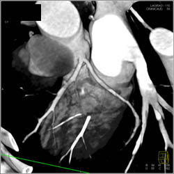 Normal Coronary Arteries - CTisus CT Scan