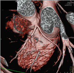 Normal Coronary Arteries - CTisus CT Scan