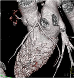 Normal Coronary Arteries - CTisus CT Scan