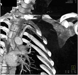 Injured Axillary Artery at GSW - CTisus CT Scan