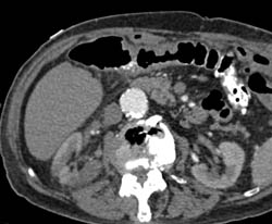 Occluded SMA With Ischemia - CTisus CT Scan