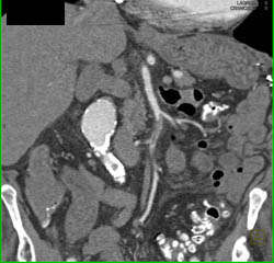 SMA Occlusion With Thrombus and Ischemic Bowel - CTisus CT Scan