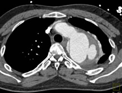 Aortic Dissection With Intramural Hematoma and Ulceration - CTisus CT Scan