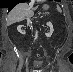 IVC Filter With IVC Clot - CTisus CT Scan