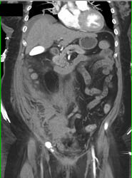 Bleed RLQ With Active Extravasation and Pseudoaneurysm - CTisus CT Scan